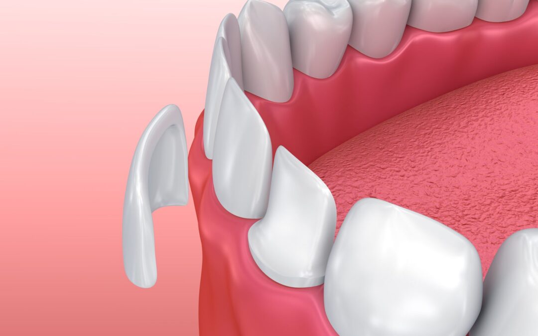 Smile Design Enhanced with Porcelain Veneers